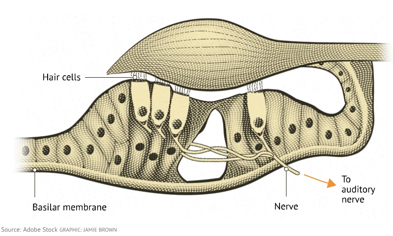 Article - Presbycusis Presbycusis